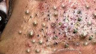 Big Cystic Acne Blackheads Extraction Blackheads amp Milia Whiteheads Removal Pimple Popping  523 [upl. by Dahlstrom]