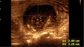 Thyroid colloid cyst  Thyroid cyst  Colloid goiter [upl. by Eetnwahs]