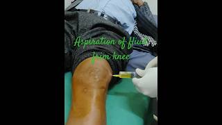 Knee joint aspiration  swollen knee due to prp injection💉🩺🏥orthopedics kneeinjection kneepain [upl. by Aeret759]