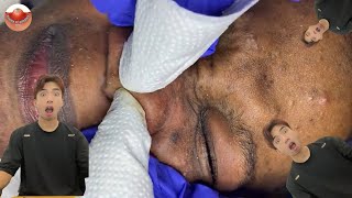 The MOST TERRIFYING Acne Squeezing Videos Youve Ever Seen 6 [upl. by Christel633]