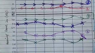 Audiogram  Assessment of Type of Hearing Loss  Part 2 [upl. by Nived]