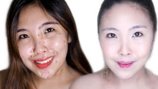 HOW I CLEARED MY SKIN ACNE SCARS CHICKEN POX SCARS  PHILIPPINES [upl. by Htide]