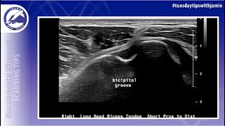 Biceps Tendon Rupture Shoulder Ultrasound Protocol [upl. by Akimal]