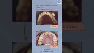 Orthodontics Fastbraces very severe periodontal case treated by Dr Evangelos Viazis 30092024 [upl. by Ratep840]