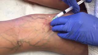 Watch This Vein Disappear  Sclerotherapy Vein Removal [upl. by Kcirederf164]