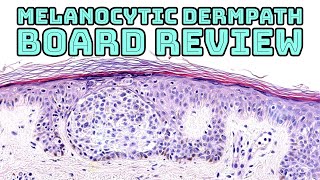 Melanocytic Dermpath Board Review melanoma blue nevus other nevi amp mimics pathology dermatology [upl. by Kimberly]