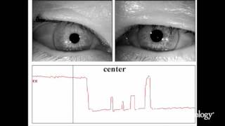 Nucleus prepositus hypoglossi lesions produce a unique ocular motor syndrome 12 [upl. by Aneeuqal]