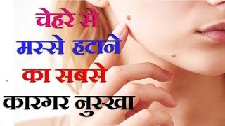 7 दिन में चेहरे से मस्से हटने का सबसे आसान घरेलू नुस्खा\\ 100Remove skin warts easily at Home [upl. by Groark]