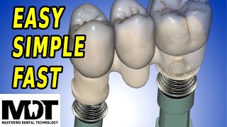 TI Base Screw Retained Crown Pressed to Metal  An Exocad Design Tutorial [upl. by Nnor]