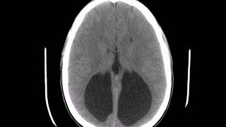 Colpocephaly CT [upl. by Efar]