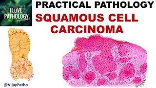 SQUAMOUS CELL CARCINOMA Clinical features amp Morphology Premalignant lesions [upl. by Keever]