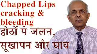 Exfoliative Chelitis severe dry chapped lips [upl. by Arick]