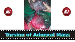 Adnexal Torsion Part I [upl. by Meedan]