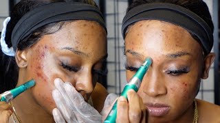 Microneedling at Home  Acne Scars Dark Spots Hyperpigmentation ft Dr Pen A6S [upl. by Odessa]