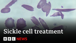 UK approves gene therapy to cure two blood disorders  BBC News [upl. by Bohlin]