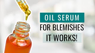 Get Rid of Blemishes with This Serum Formula  It Works [upl. by Rahmann]