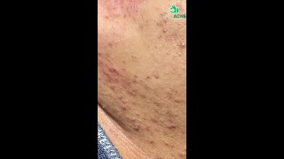 Massive Blackhead Extraction CloseUp of Every Pore [upl. by Charlet]