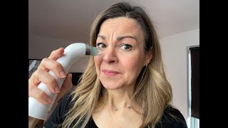 Review Do blackhead remover vacuums work and are they a good idea [upl. by Yarezed]