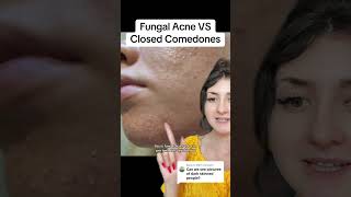 Fungal Acne VS Closed Comedones shorts acne [upl. by Jezebel]