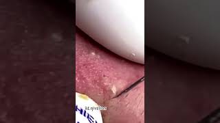 Blackheads Removal  Acne Treatment and Very Satisfying Satisfying Pimple pop blackheads [upl. by Avla682]