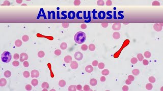 anisocytosis ।। microcytic normocytic and macrocytic cells of rbc [upl. by Cirederf460]