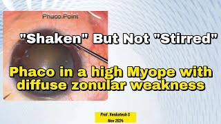 quotShakenquot but not quotStirredquot  Phaco in a High Myope with Diffuse Zonular Weakness Both Eyes Surgery [upl. by Gwynne]