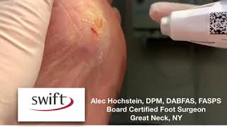 Swift Verrucae Treatment with Dr Hochstein [upl. by Rett]