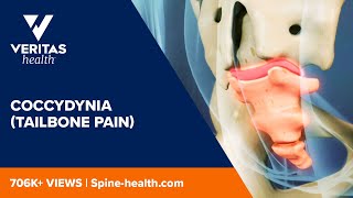 Coccydynia Tailbone Pain [upl. by Masry]