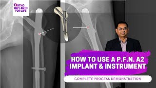 How To Use PFN A2 Implant and Instrument [upl. by Ifill]