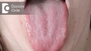 Diagnosis for red lesions present on tongue surface  Dr Jayaprakash Ittigi [upl. by Gratia]