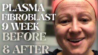 PLASMA FIBROBLAST BEFORE AND AFTER 9 Week Results  Plasma Pen At Home  Snow Skin Co [upl. by Tessy926]