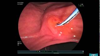 Choledocholithiasis  Sphincterotomy and Stone Extraction with a Basket [upl. by Jestude]