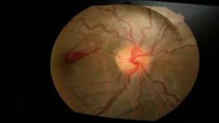 Yag Laser Hyaloidotomy for a pre macular haemorrhage [upl. by Lockwood]