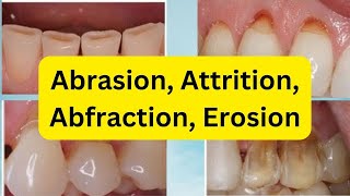 Abrasion Attrition Erosion Abfraction SIMPLIFIED [upl. by Maximilien]