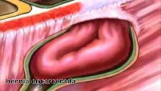 GASTROCIRURGIA  Vídeos  Hérnia Encarcerada [upl. by Ahseem]