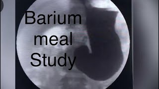 Barium meal study [upl. by Ynabla]