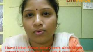 Lichen Planus treated by Dr Rajesh Shah at Life Force [upl. by Lativa]