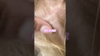 Nits on hair l lice removal service explore hairtok headlice hair [upl. by Aseek918]