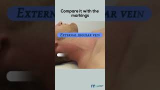 Examination of Jugular Venous Pulse [upl. by Eahsat]