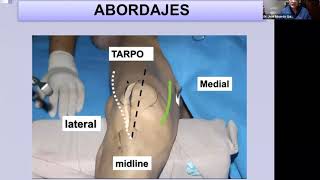 Webinar MIO en fémur distal indicaciones técnica y complicaciones [upl. by Yelime]