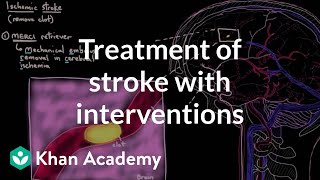 Treatment of stroke with interventions  Circulatory System and Disease  NCLEXRN  Khan Academy [upl. by Savina641]