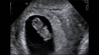 What Can You See At A 9 Week Baby Scan [upl. by Rehpoitsirhc57]