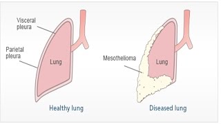 Pleural Mesothelioma  Asbestosis Symptoms and Treatment  Malignant Peritoneal Mesothelioma [upl. by Grimbald]