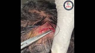 HEAD SUTURE REMOVAL  SUTURE KAISE NIKALE  SUTURE KAISE REMOVE KARE  SUTURE REMOVAL PROCEDURE [upl. by Neeven]