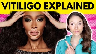 Vitiligo WHY YOU HAVE IT amp WHAT TO AVOID [upl. by Greenstein]