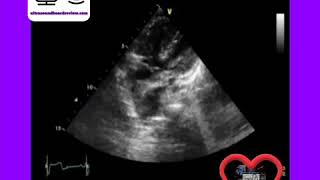 Tetralogy of Fallot [upl. by Orelle72]