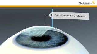 Keratoconus treatment using LIKE midstromal pocket  Lenticular Intrastromal Keratoplasty [upl. by Hirsch]