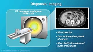 Pancreatic Cancer Pathophysiology Diagnosis and Staging [upl. by Ahsaetal]