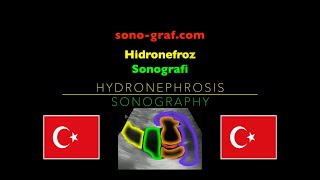 Sonografi  Hidronefroz [upl. by Malvia]