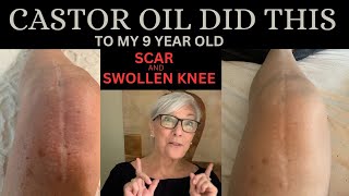 CASTOR OIL DID THIS TO MY 9YEAROLD SCAR AND SWOLLEN KNEE [upl. by Gant676]